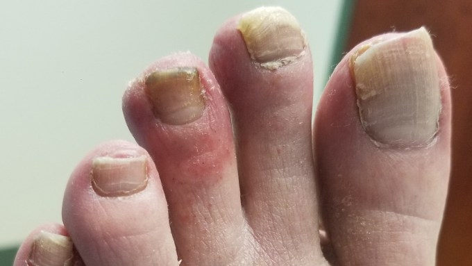 A close-up image of discolored, swollen toes